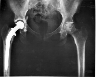Displasia do quadril: raio X de cachorro