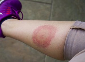 Doença de Lyme: tudo que você precisa saber