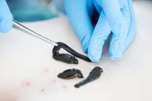 Tratamento com sanguessugas