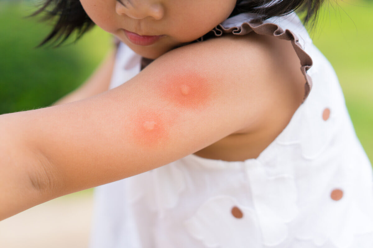 Uma garota que foi picada por um mosquito.